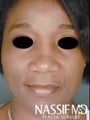 African American Female Rhinoplasty 