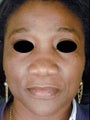 African American Female Rhinoplasty 