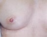 Female patient who underwent a breast augmentation for inverted nipples 