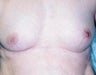 Female patient who underwent a breast augmentation for inverted nipples 