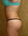 Butt Augmentation