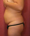 Butt Augmentation
