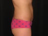 Liposuction of abdomen and waist