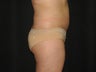 Liposuction of abdomen and waist