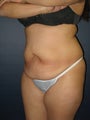 Tummy Tuck
