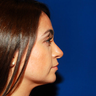 Chin Augmentation 