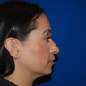 Chin Augmentation 