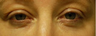 Madonna Lift one week after Smartskin for upper and lower lid wrinkles