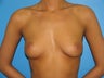 26 yr old woman for Breast Augmentation