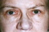 Blepharoplasty