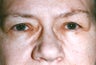 Blepharoplasty