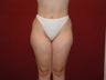 Traditional Liposuction