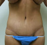 Body Lift