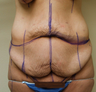 Body Lift