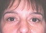 Female patient who underwent a brow lift 
