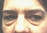 Female patient who underwent a brow lift 