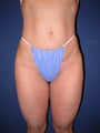Liposuction