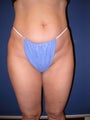 Liposuction
