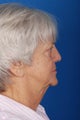 Revision Rhinoplasty