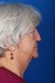 Revision Rhinoplasty