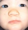 Infant who underwent surgery for a cleft lip and palate 