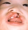 Infant who underwent surgery for a cleft lip and palate 