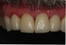 Dental Veneers