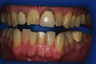 Dental Veneers