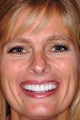Female Treated with Porcelain Veneers