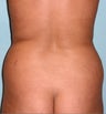 Liposuction Combined with Tummy Tuck