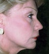 Neck Liposuction