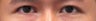 Revision Bilateral Asian Eyelid Surgery