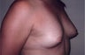 Breast Augmentation