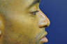 Non Surgical Nose Job