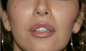 Upper Lip Lift or Lips 