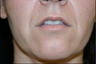 Upper Lip Lift or Lips 