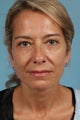 Facelift