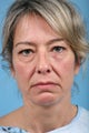 Facelift