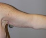 52 year old woman has Arm Lift 