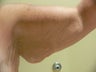 52 year old woman has Arm Lift 