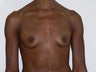 Breast Augmentation through the areola under the muscle