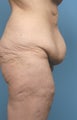 45 Year old Female Treated For Large Weight Loss