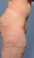 45 Year old Female Treated For Large Weight Loss