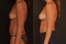 fat enhancement of breasts