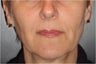 Juvederm