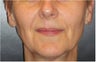 Juvederm