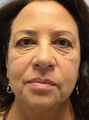 56 year old Female treated for under eye bags and prejowls around the the chin 