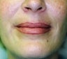 Female patient who underwent a lip augmentation 