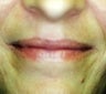 Female patient who underwent a lip augmentation 