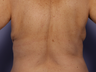 CoolSculpting by Zeltiq to Bra Rolls